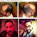 A.J. McLean reveals hair transplant - A.J. McLean has admitted to getting a hair transplant.The 35-year-old Backstreet Boys crooner went &hellip;